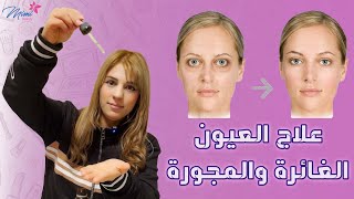 علاج العيون الغائرة والمجورة