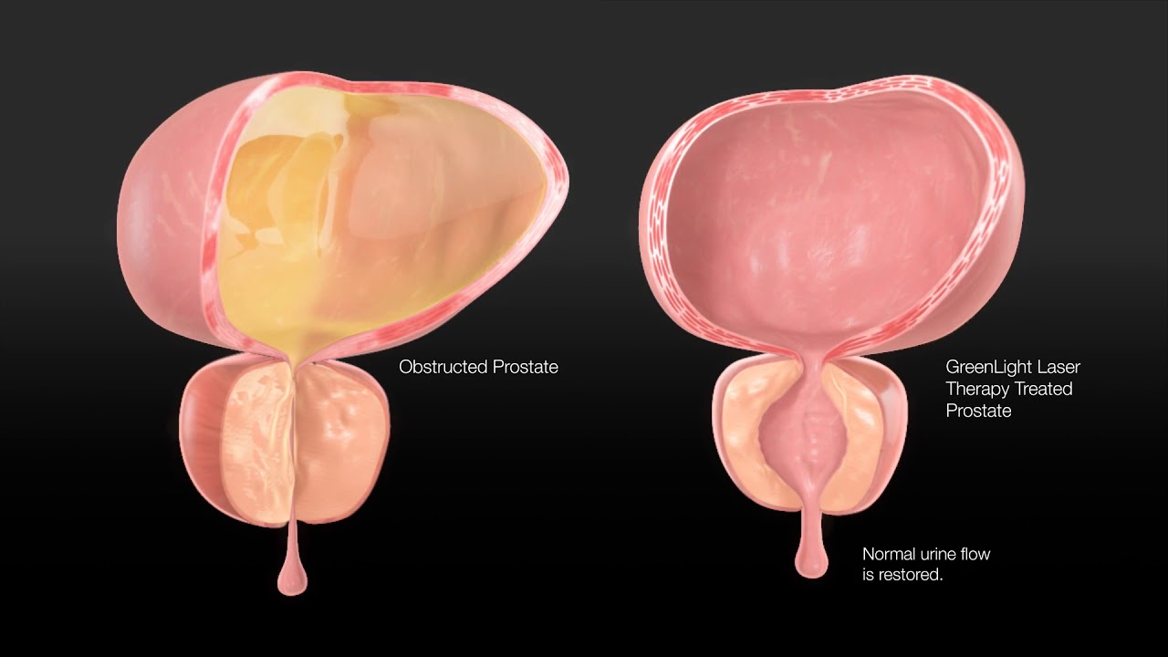 adenoma prostatico with normal heart