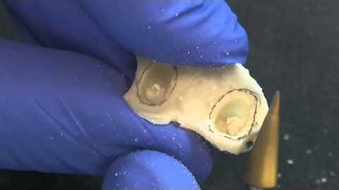 How to reline a processed Temporary by Dr. Marshall Fagin Prosthodontist
