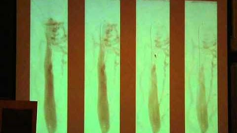 Dr. Dake Lecture Part 3 - Hubbard Foundation 2011 CCSVI Conference