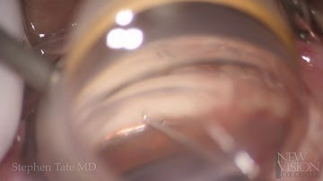 Hydrus Microstent Insertion with Tips for Eye Surgeons in 4k