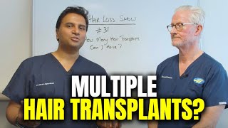 How Many Hair Transplant Surgeries Can You Have?