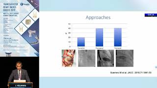 J. Velianou | Results of valve-in-MAC (mitral annular calcification) procedures.