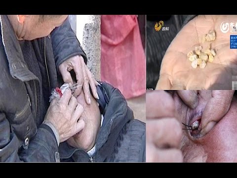 Video: A Chinese Woman Has Large Stones The Size Of Beans Coming Out Of Her Eyes - - Alternative View