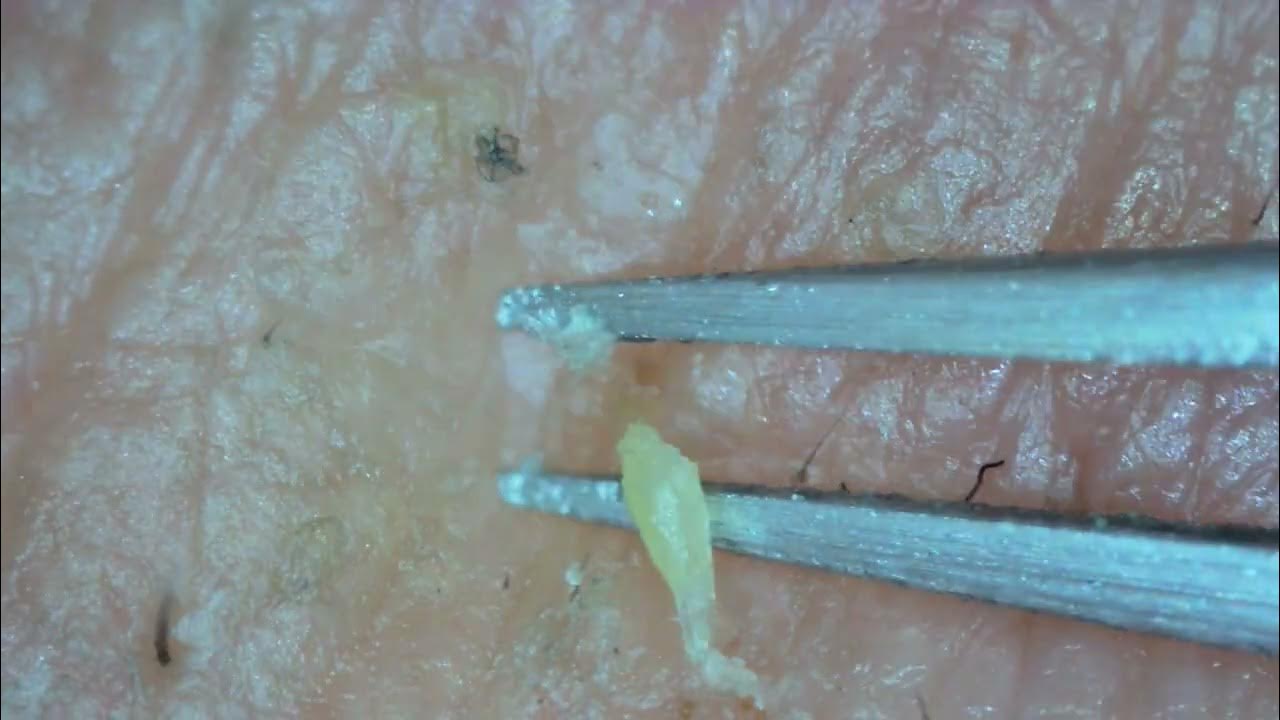0237 keratin plug removal chin YouTube