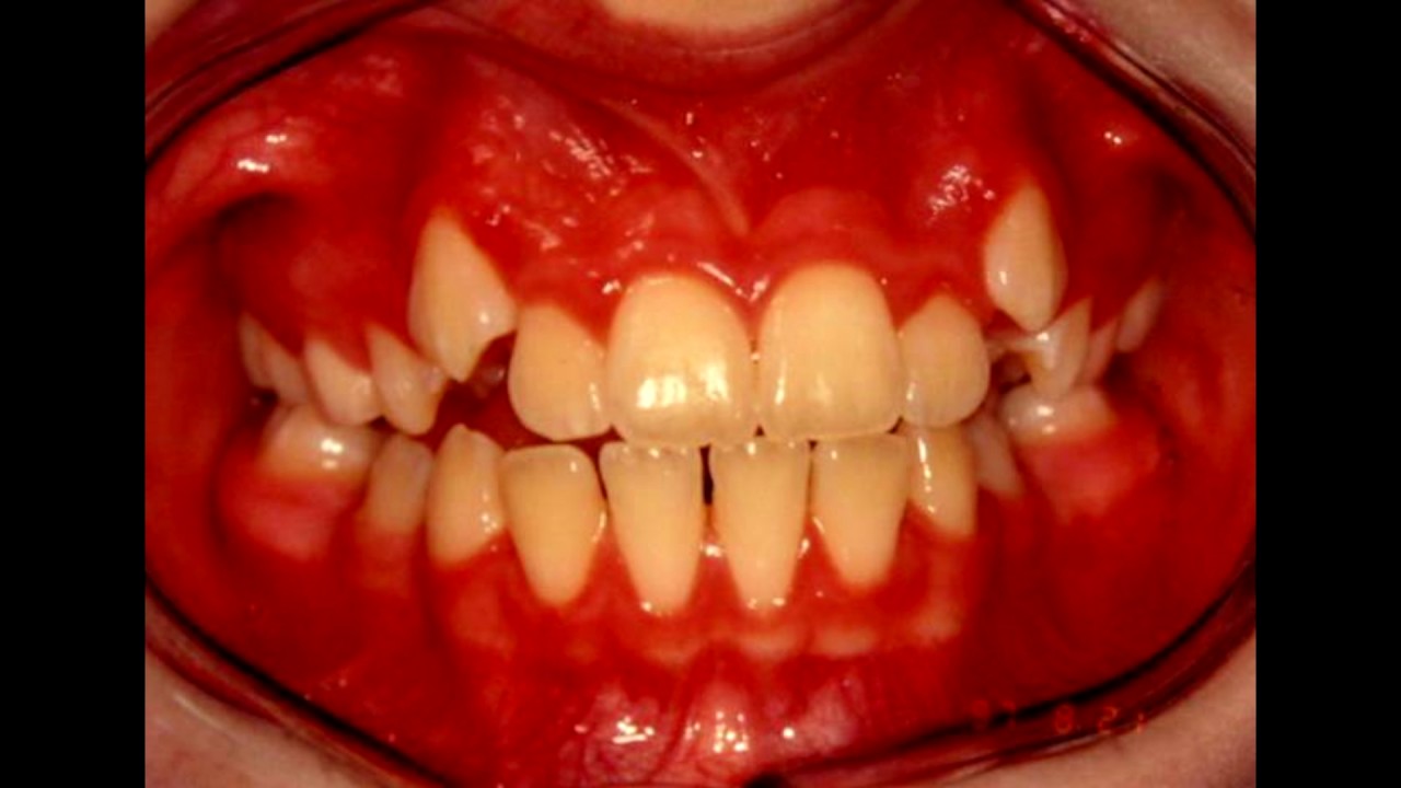 Why Does My Child Have Fangs? YouTube