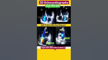 हार्ट वाल्व लीक इको l Valve Regurgitation Echo #echo #heart #shorts