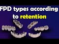 Fixed Partial Denture "Bridge" types according to the retention