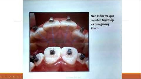 Chỉnh nha phẫu thuật bài 1 : Cách gắn mắc cài p1