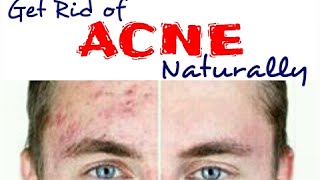 Get rid of acne naturally & fast | diy spot treatment life hack cheap
tip #227