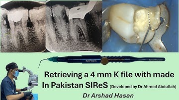 Removal of a separated 4mm k file.