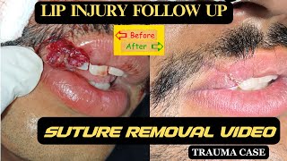 LIP INJURY SUTURE REMOVAL | LIP INJURY FOLLOW UP | LIP INJURY PRE & POST MANAGEMENT | LIP TRAUMA