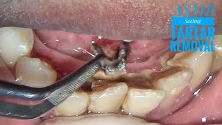 Relaxing Tartar Removal With @dentist_ruli Female 28 y.o.| ASMR | Dentist | Scaling