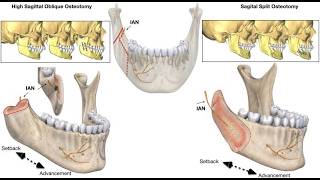 Bilateral sagittal split osteotomy BSSO And Genioplasty; orthognathic jaw surgeries performed