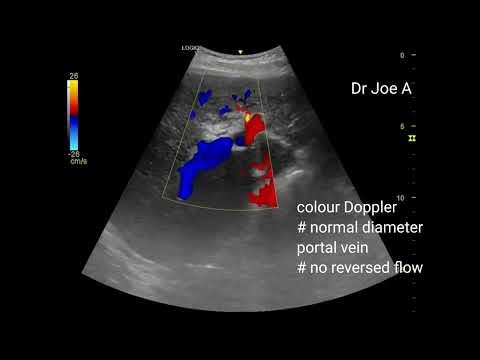 Coarse liver echotexture- early sign of cirrhosis- ultrasound video