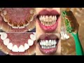 Turn dirty yellow teeth to White in just 3 minutes | Teeth whitening at home | whiten my teeth overn