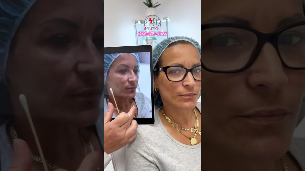 Estiramiento Facial sin cirugía en Miami, FL (786)-359-4068 