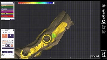 exocad screw retained bridge