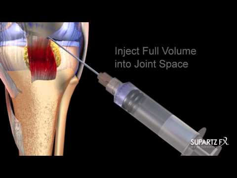 Supartz FX MOA HD