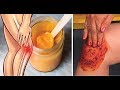 People Go Crazy For This Recipe! It Heals Knee, Bone and Joint Pain People Go Crazy For This Recipe! It Heals Knee, Bone and Joint Pain