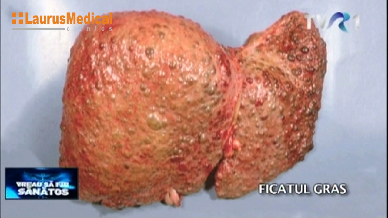 ciroza hepatica si varice esofagiene