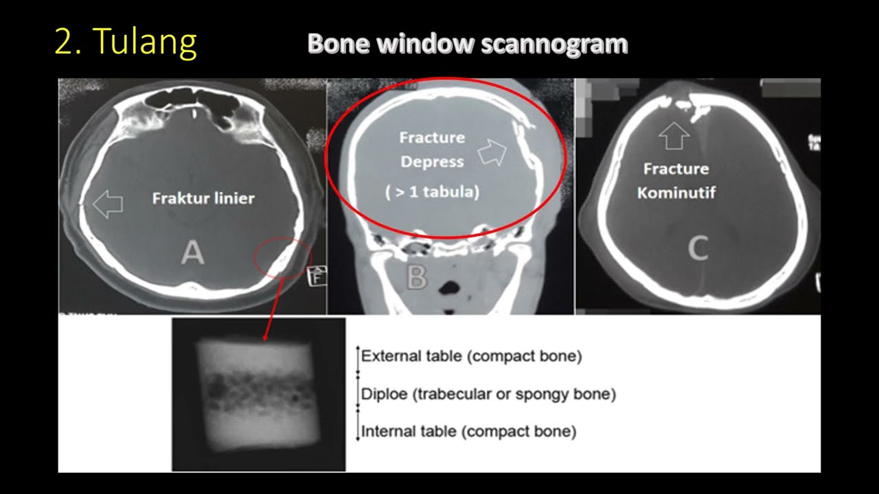 Cara Praktis Membaca dan Memahami CT Scan Kepala by Dr. dr. Ardik Lahdimawan, Sp.BS(K)