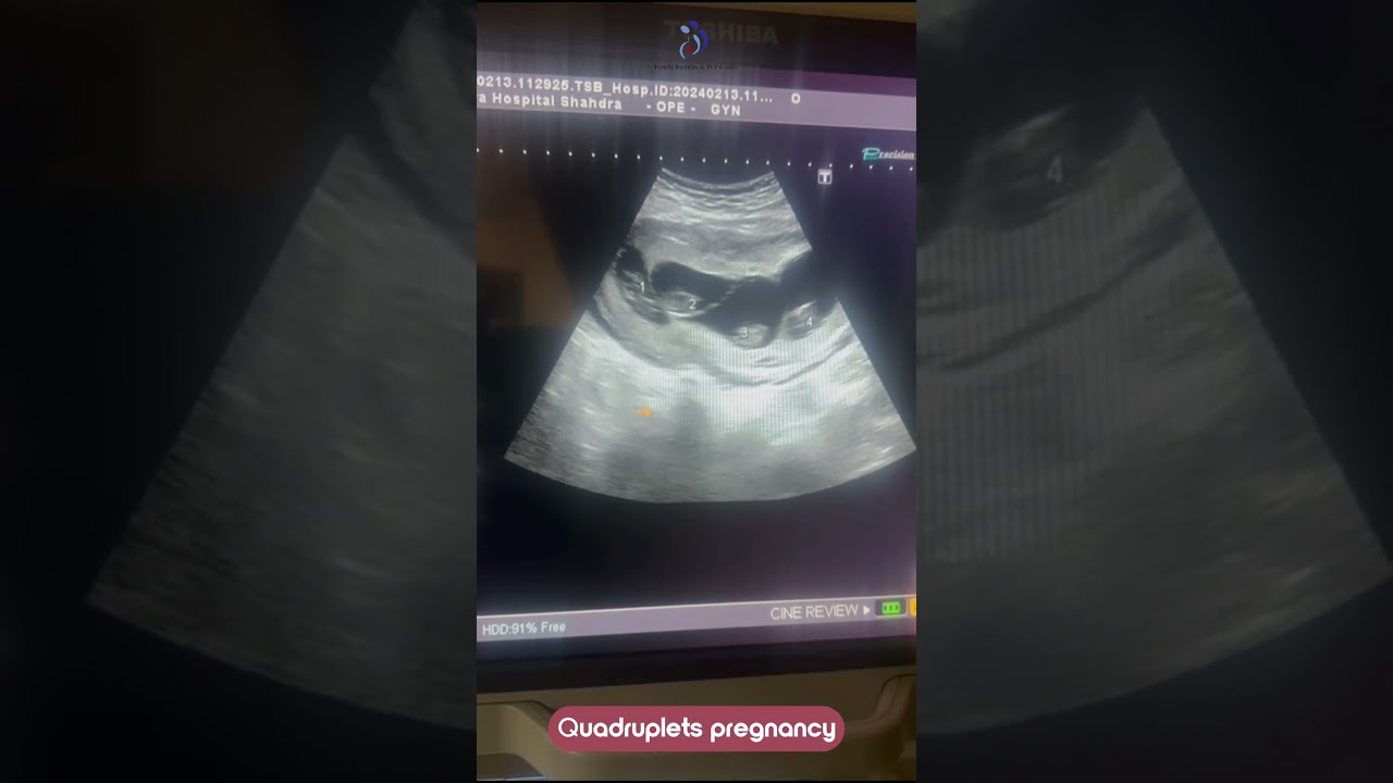 #ivf #quadrupletspregnancy #embryofreezing #pregnancy