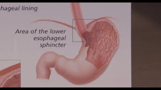 Understanding GERD