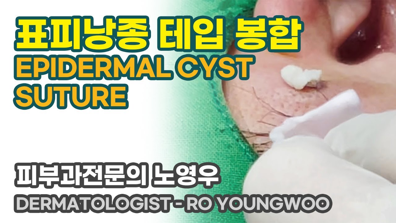 표피낭종 Co2 레이저로 수술 20.02 - YouTube 표피낭종 Co2 레이저로 수술 20.02 - Youtube