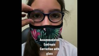 Accommodative Esotropia Corrected With Gl