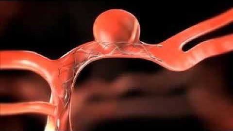 Stent assisted coiling