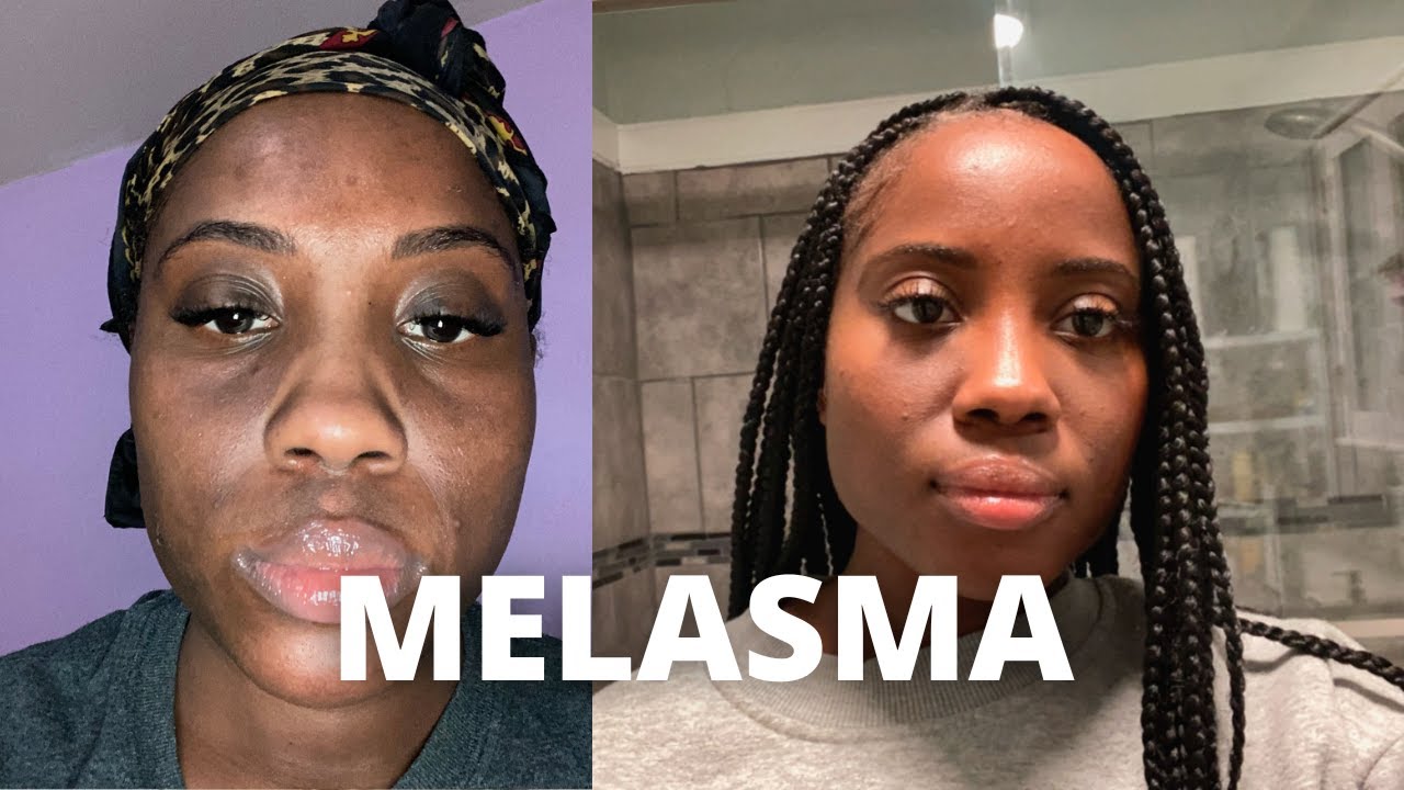 Melasma Skin Care Routine ft. Faded Topicals Cream Skincare and Therapy YouTube