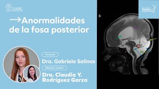 Anormalidades de la fosa posterior por la Dra. Gabriela Salinas.