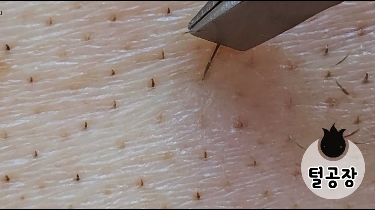 [다발모] 털공장 20220117 (Sebaceous Filaments, Pili Multigemini) [PiliPili ...