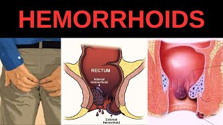 Hemorrhoids Signs & Symptoms Internal vs. External Hemorrhoid Symptoms  Hemorrhoidal Disease