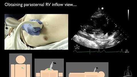05. Right ventricular inflow & outflow views