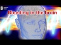 Bleeding in the brain  dr avinash k m