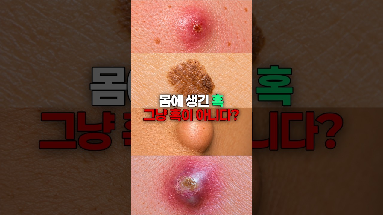 몸에 생긴 혹, 그냥 방치하면 평생 흉터로 남습니다