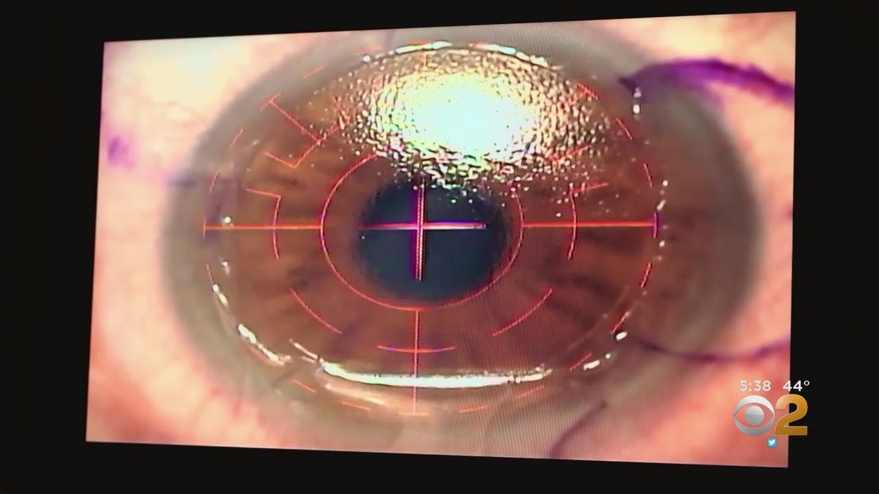 ⁣FDA Finds Lasik Eye Surgery Complications