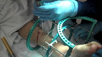 Removal of External Fixation