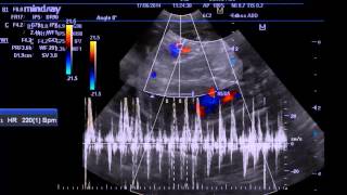 Gestação Com Teratogênese Pulmonar
