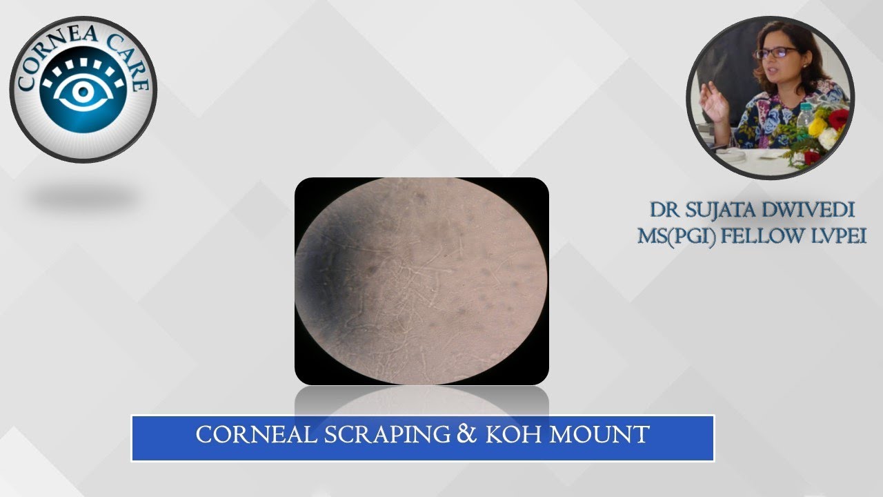 Corneal Scraping & KOH wet mount YouTube