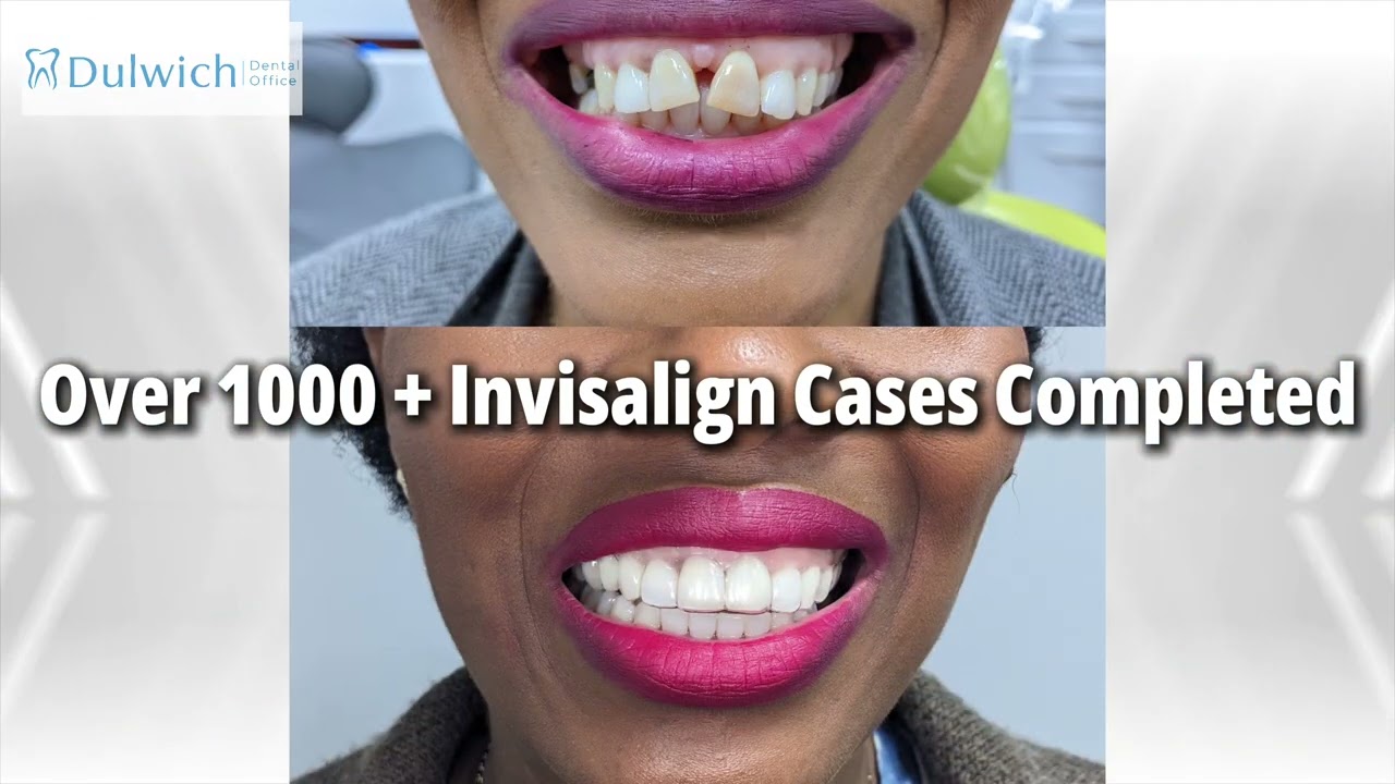 Dulwich, London Invisalign | Number 1 Clinic | Dulwich Dental Office