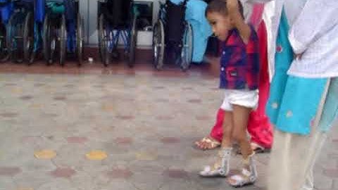child with cerebral palsy after injection of botulinum toxin a