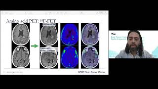 Advanced Imaging Technologies for Brain Tumors - Javier Villanueva-Meyer, MD