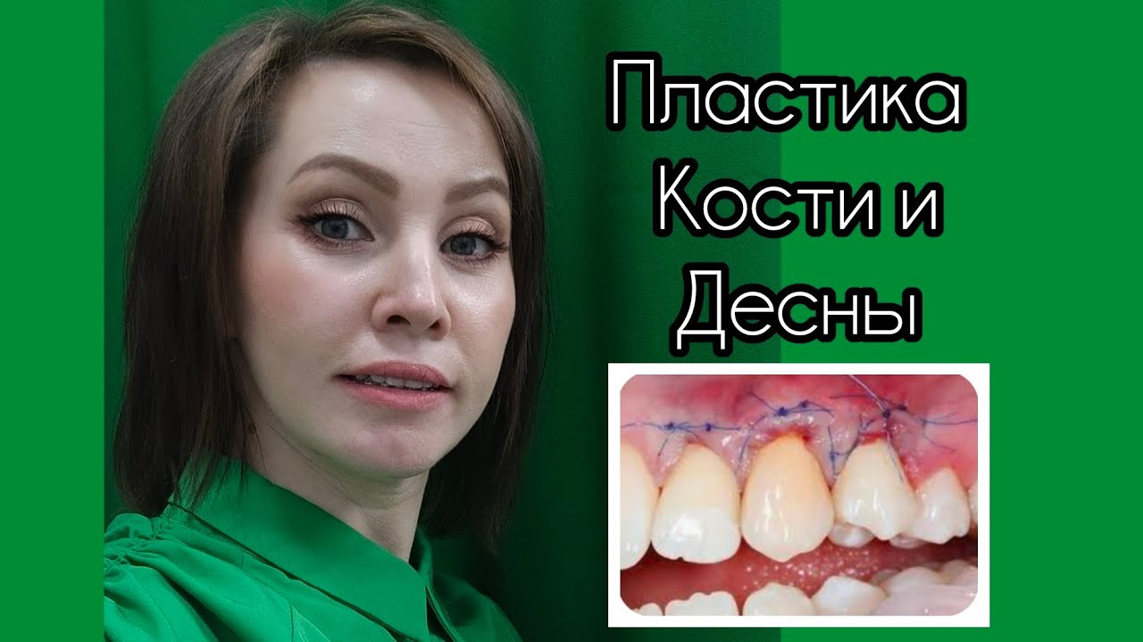 #27 Костная и мягкотканная пластика. До или После ЧЛХ??? 9 месяцев после операции.