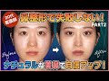 【20代女性の鼻整形ビフォーアフター】ぺちゃんこ鼻から卒業!術後6ヶ月インタビュー「やってよかった!」自然な変化に大満足【後編】