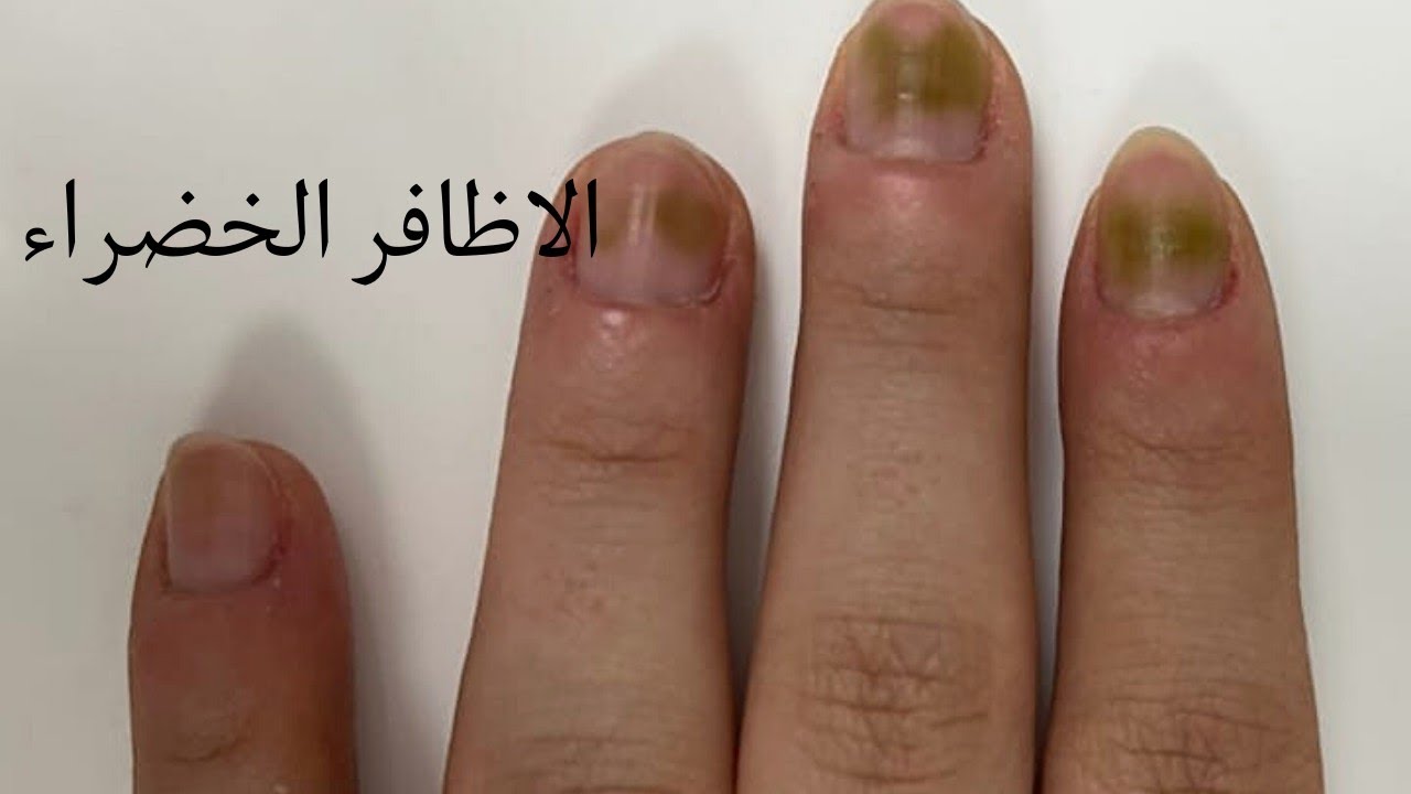 الاكريليك والجيل أظافر اصطناعية ومتلازمة الاظافر الخضراء