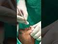 Scar Removal Scar Revison Scar Surgery Scar Cost Shortvideo Dezireclinicindia 