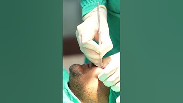 Thumbnail of Scar Removal | Scar Revison | Scar Surgery | Scar cost #shortvideo #dezireclinicindia